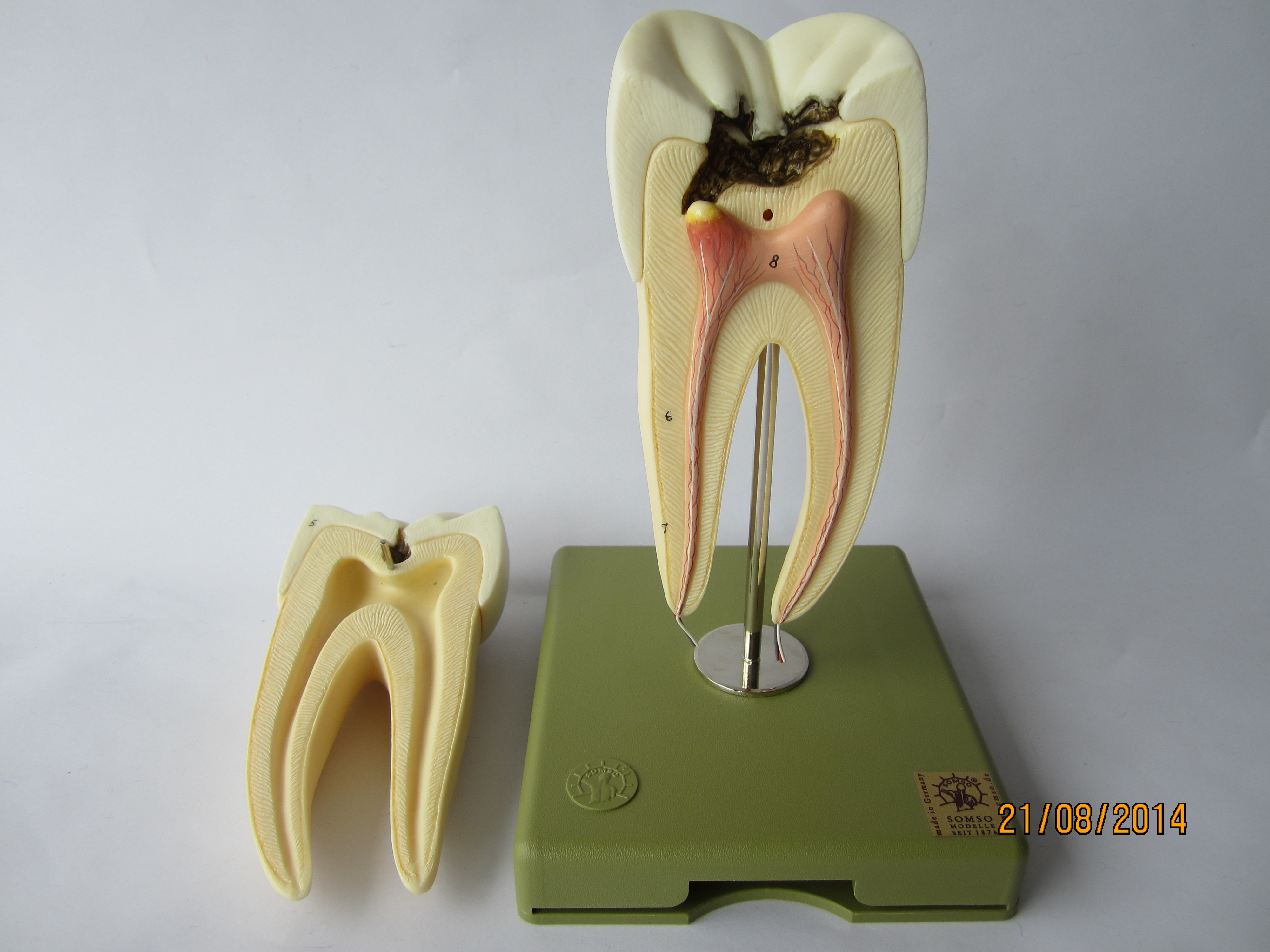 Backenzahn mit Karies: 8-fach vergrößert, zerlegbar in 3 Teile © Original SOMSO®Modell